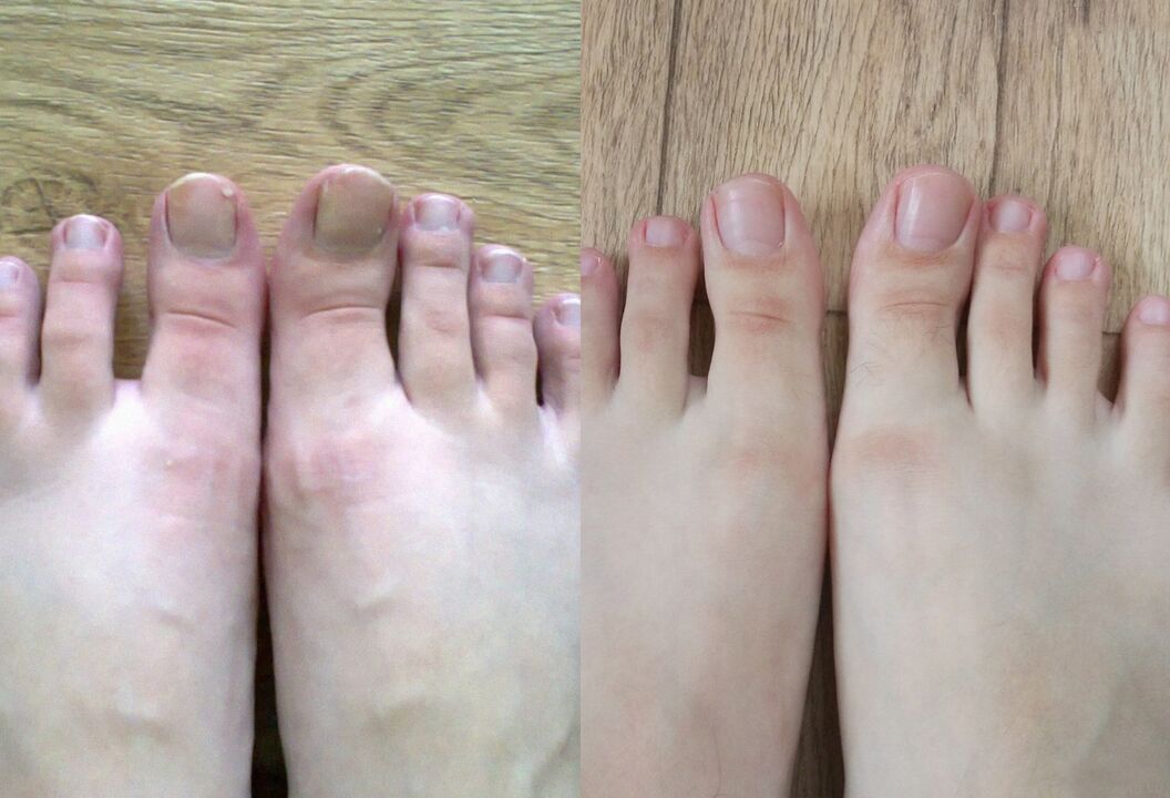 Antes e depois do tratamento, o fungo Promisil Cream