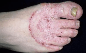 As razões para o aparecimento do fungo nas pernas