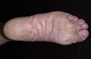 Sinais e sintomas de fungo nas pernas