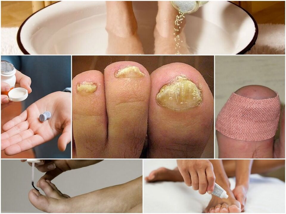 Tratamento de fungo das unhas