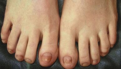 Estágios de desenvolvimento de fungos de unhas