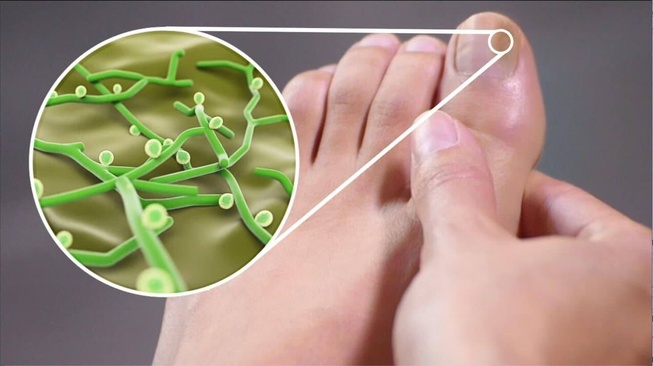 patógenos do fungo das unhas