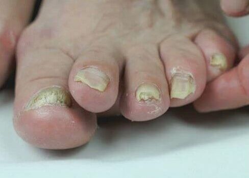 tratamento de fungos nas unhas com medicamentos