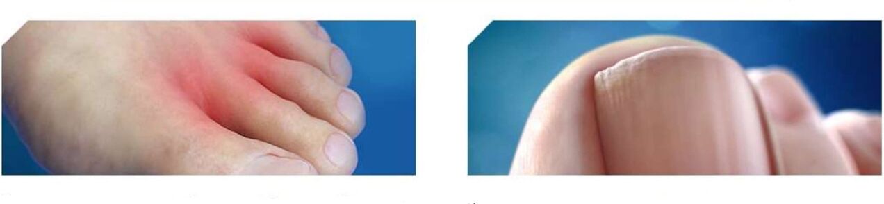 estágio inicial do fungo no pé