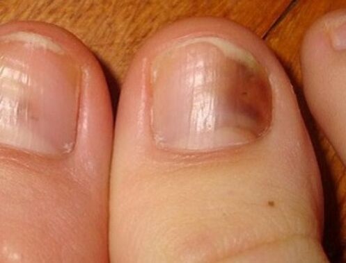 sintomas de fungo nas unhas